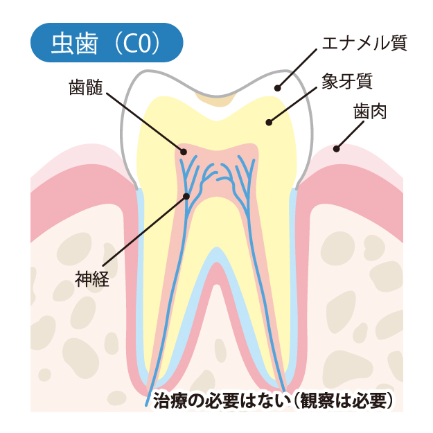 新潟（新潟市中央区本馬越）の歯医者、齋藤歯科医院で、むし歯治療