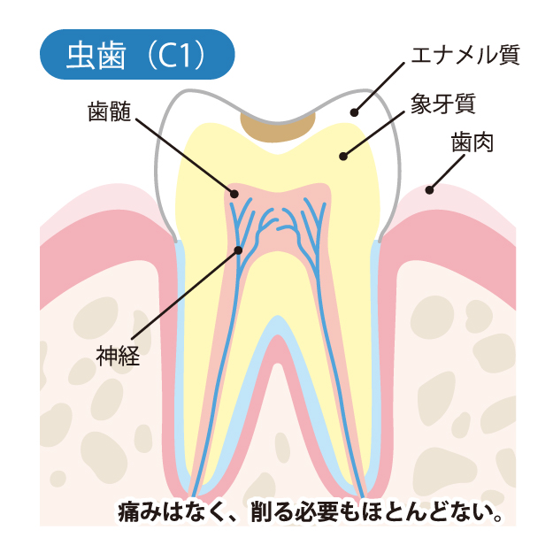 新潟（新潟市中央区本馬越）の歯医者、齋藤歯科医院で、むし歯治療