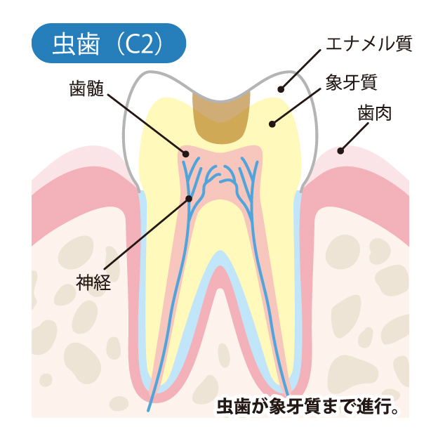 新潟（新潟市中央区本馬越）の歯医者、齋藤歯科医院で、むし歯治療