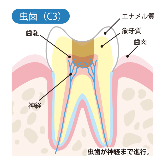 新潟（新潟市中央区本馬越）の歯医者、齋藤歯科医院で、むし歯治療