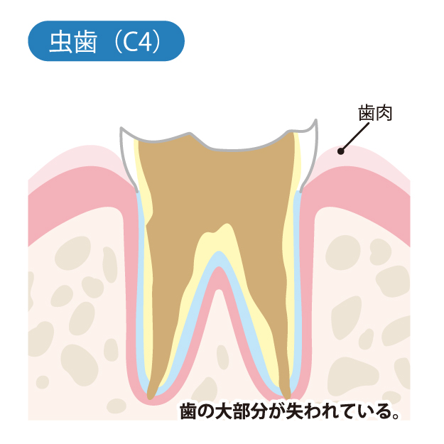 新潟（新潟市中央区本馬越）の歯医者、齋藤歯科医院で、むし歯治療