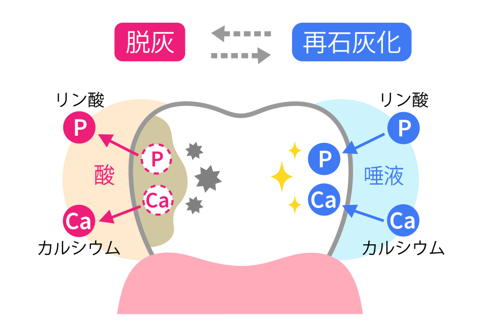 新潟（新潟市中央区本馬越）の歯医者、齋藤歯科医院で、むし歯治療