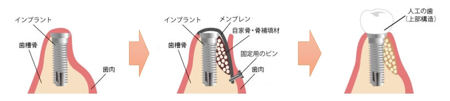 新潟（新潟市中央区本馬越）の歯医者、齋藤歯科医院で、GBR法