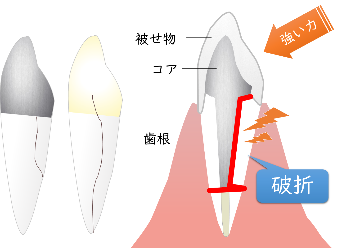 新潟（新潟市中央区本馬越）の歯医者、齋藤歯科医院で、根管治療