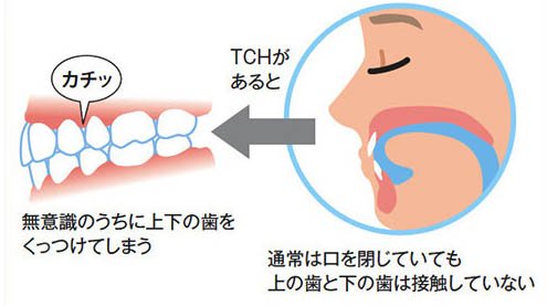 新潟（新潟市中央区本馬越）の歯医者、齋藤歯科医院で歯列接触癖対策