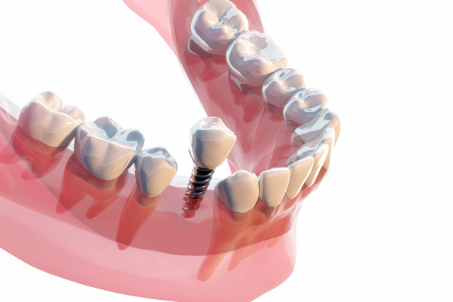 ［新版］現代の臨床補綴　刺繍治療をふまえた補綴・インプラント治療 書籍 - 御堂筋線新大阪駅から徒歩5分 - 歯周病・インプラント治療